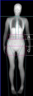 Associations of Fat Mass and Fat Distribution With Bone Mineral Density in Non-Obese Postmenopausal Chinese Women Over 60 Years Old